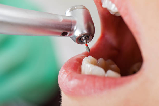 Best Emergency Dentist for Knocked-Out Tooth in Lemon Grove, CA